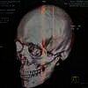 Foto X-Ray Tengkorak Kepala Hamish Daud