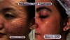 Leny Skincare Perkenalkan REMEE Pro Injector: Teknologi Canggih untuk Skinbooster Minim Rasa Sakit