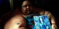 Lambung Wanita Berbobot 350 Kg Diperkecil, Hasilnya Mengejutkan