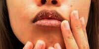 6 Cara Mengatasi Bibir Kering