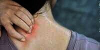 Penyebab dan Tips Mencegah Jerawat Punggung