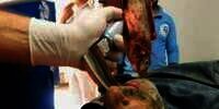 Dokter Berhasil Keluarkan Ikan Hidup dari Tenggorokan Nelayan
