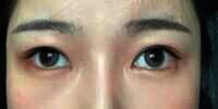 Salah Pakai Softlens, Mata Wanita ini Jadi 'Juling'
