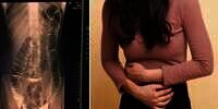 Sering Alami Sembelit, Kondisi Organ Wanita Ini Bikin Ngeri