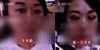 Sudah Hasil Operasi Double Eyelid Gagal, Istri Terancam Diceraikan