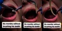 Akibat Tidak Gosok Gigi Enam Bulan Keluar Benda Mirip Cacing dari Mulut, Cek Faktanya!