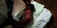 Kasihan, Bayi Lahir Cacat Tanpa Kaki, Digantikan Tulang Besar Mirip Tanduk