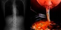 Batuk Usai Konsumsi Makanan Pedas, 4 Tulang Rusuk Wanita Ini Patah