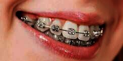 Hukum Memakai Kawat Gigi dalam Islam