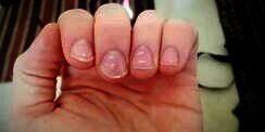 Lihat Bercak atau Garis Putih Pada Kuku, Waspadalah!