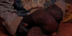 Kulit Anak Ini Perlahan Membatu Seperti Kisah Malin Kundang