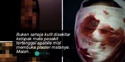 Pengalaman Dokter Rawat Pasien Pengguna Kosmetik Bermerkuri