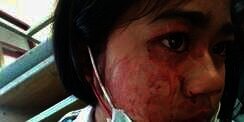 Gadis Ini Nangis Darah Tiap Sakit Kepala, Ternyata Sebabnya...
