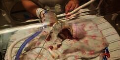 Di Kandungan 23 Minggu, Saat Lahir Bayi Panjangnya Hanya 22 Cm