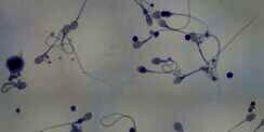 Mengenal Azoospermia, Pemicu Kemandulan Pria