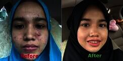 Dulu Wajah Penuh Jerawat Batu, Bisa Cantik Hanya dalam 4 Bulan