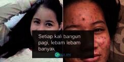 Berjerawat Mengerikan, Wanita Ini Mengaku Kena `Ilmu Hitam`