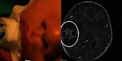 Komedo di Hidung Dipencet Ibu, Si Anak Alami Hal Mengerikan