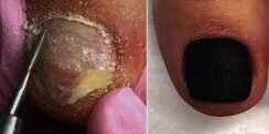 Before-After Kuku Kaki Busuk Jadi Perbincangan Warganet
