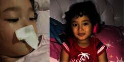 Hidung Anak Ayu Ting Ting Diperban, Kenapa?