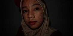 Kisah 'Pejuang Acne' Tetap Pede Lawan Jerawat