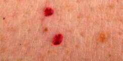 Jangan Abaikan Jika Ada Tahi Lalat Merah di Tubuh