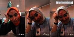 Viral Teller Bank Cantik Wajahnya Penuh Jerawat, Penyebabnya Bikin Merinding
