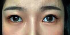 Salah Pakai Softlens, Mata Wanita ini Jadi 'Juling'