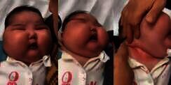 Bayi Obesitas Parah, Lehernya Berlipat hingga Terkena Infeksi Jamur