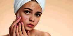 Dream Choice: 4 Skincare yang Mengandung Witch Hazel untuk Redakan Jerawat