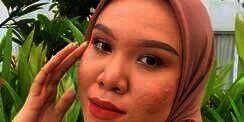 Cerita Selebgram Cut Rizki Berdamai dengan Jerawat