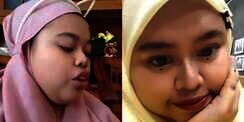 Potret Kekeyi Setelah Filler Hidung, Foto Before-After Viral