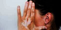 Pasien Vitiligo Kerap Alami Masalah Psikis