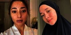 7 Seleb Cantik Pejuang Jerawat, Ada yang Sampai Parah Banget!