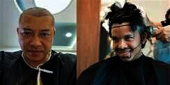 6 Potret Artis Sebelum Vs Sesudah Transplantasi Rambut, Atta Halilintar Makin Keren & Ganteng Abis!