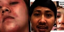 Benarkah Gejala Autoimun Muncul Akibat Suntik Putih? Dengar Penjelasan Dokter