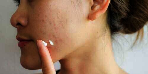 Jerawat