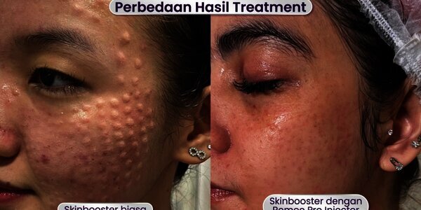 Leny Skincare Perkenalkan REMEE Pro Injector: Teknologi Canggih untuk ...