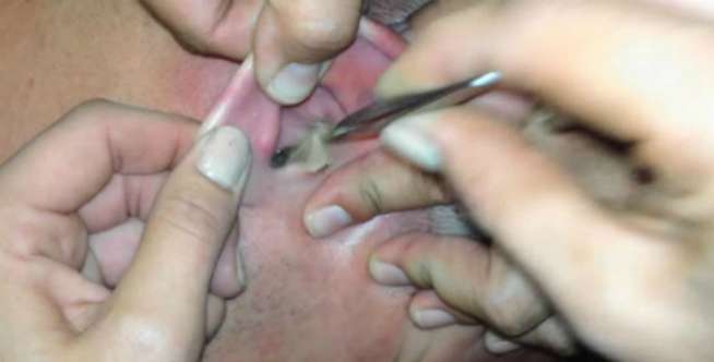 8 Cerita Horor Serangga Masuk Tubuh Manusia