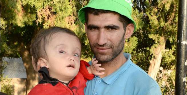 Bocah Hydrocepalus Harus Lari ke Yunani