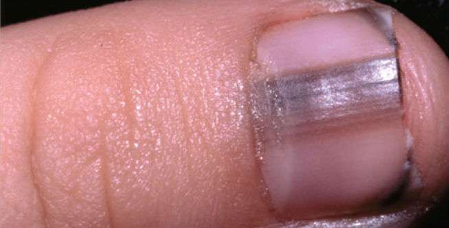 Flek Hitam atau Garis di Bawah Kuku Kaki