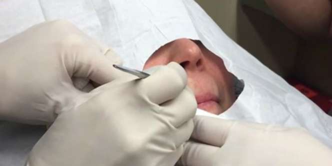 Dokter Bedah Benjolan Misterius di Bibir, Ternyata Isinya...