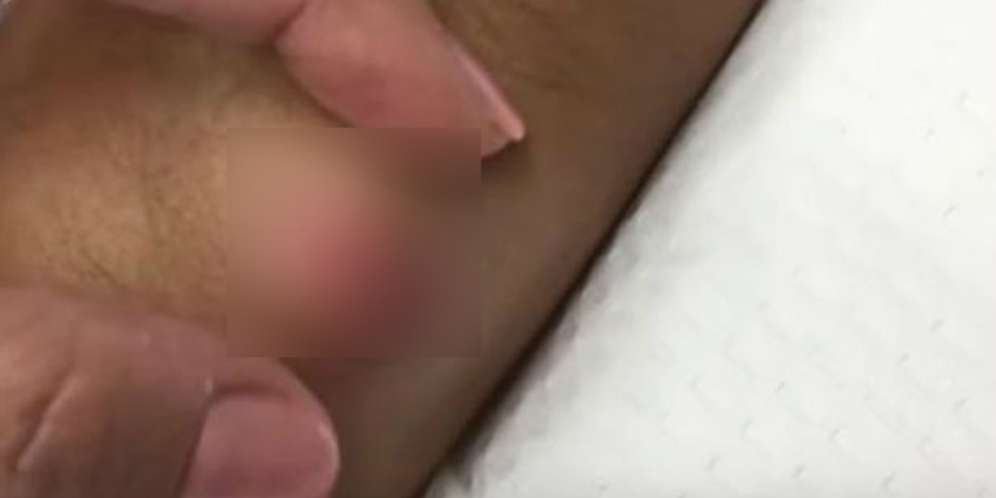 Dokter Kaget, Bedah Benjolan di Punggung Isinya...