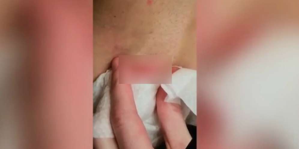 Dokter Bedah Benjolan di Bawah Perut, Ternyata Isinya...