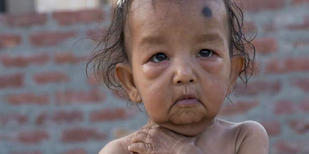 Pedihnya Hidup Bocah Berpenyakit Langka Ini