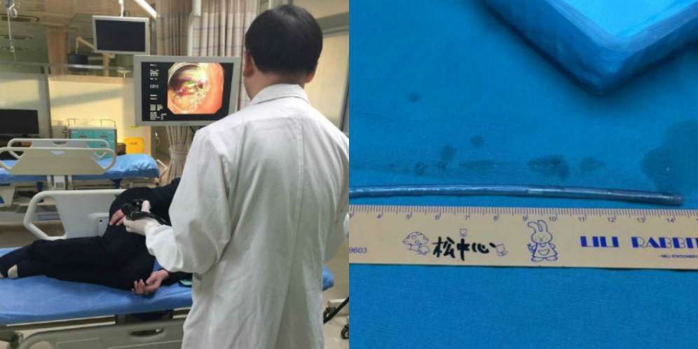 Telan Paku 15 Cm Lantaran Emosi pada Istri, Akibatnya....