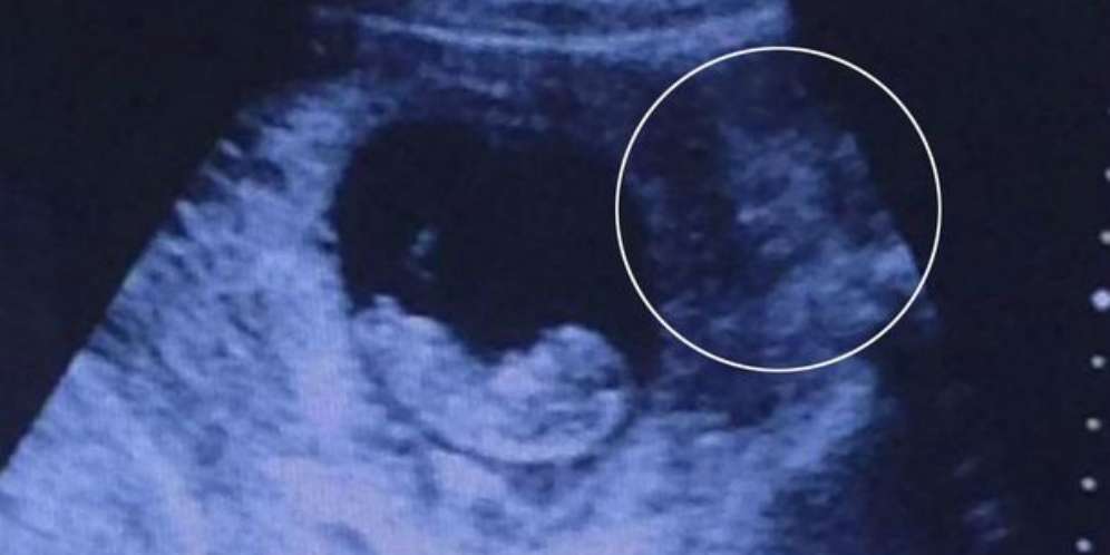 Foto USG Perlihatkan Sosok Menakutkan di Sebelah Janin
