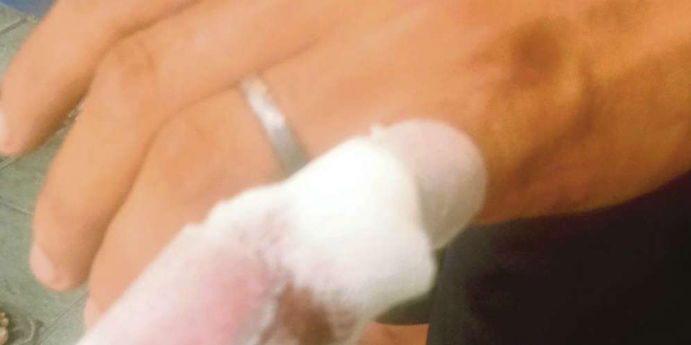 Suami Pulang Terlambat, Jari Kelingking Putus Digigit Istri