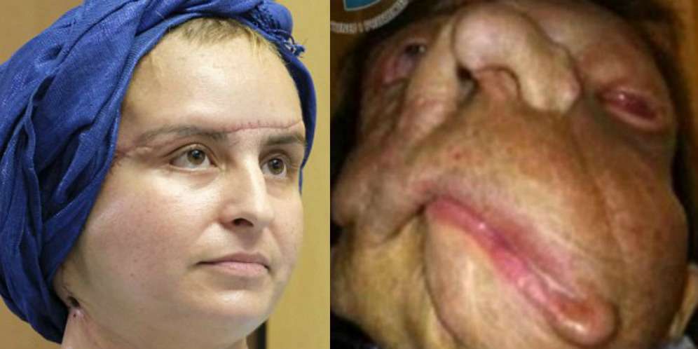Joana merupakan pasien kedua transplantasi wajah