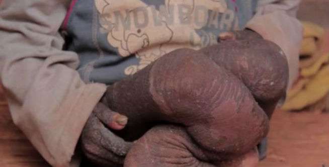Penyakit Langka Bernama Iktiosis